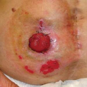 Peristomal Medical Adhesive Related Skin Injury (PMARSI)