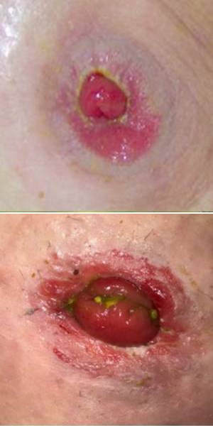 (PMASD): Irritant Dermatitis (Acute)