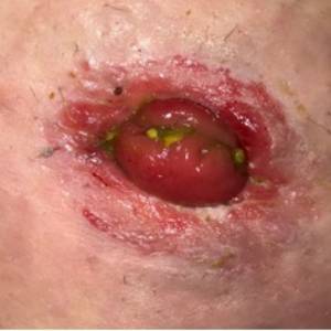Peristomal Moisture Associated Skin Damage (PMASD –Irritant Dermatitis)