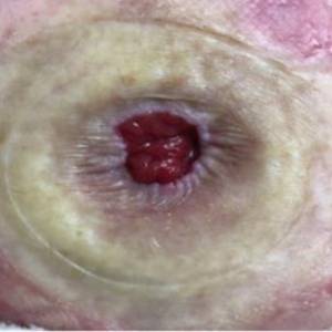 retracted-stoma